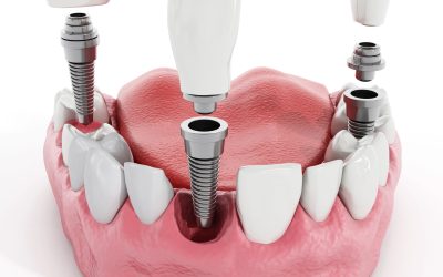 Full Mouth Dental Implants: Complete Smile Transformation