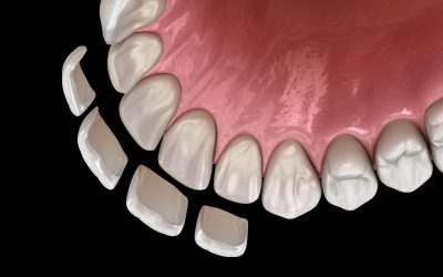 Could Porcelain Veneers Be the Smile Transformation Your Family Deserves in Anchorage?